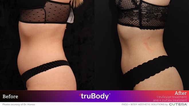 TRUSCULPT FLEX: REDEFINING MUSCLE SCULPTING.