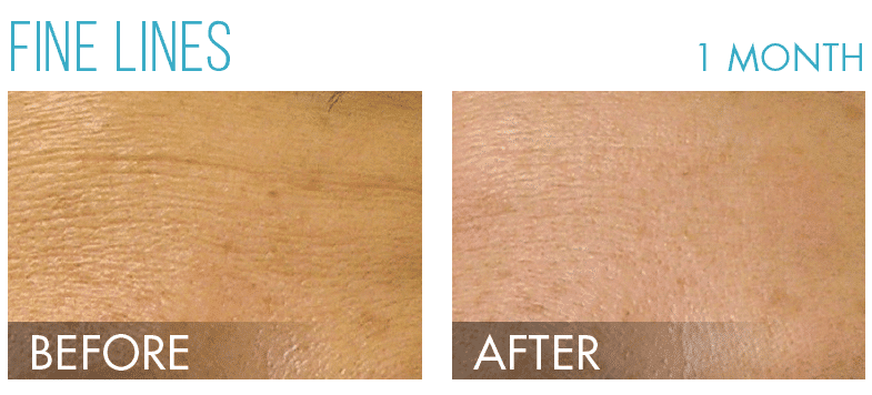 HydraFacial in Richmond, BC illustration 2