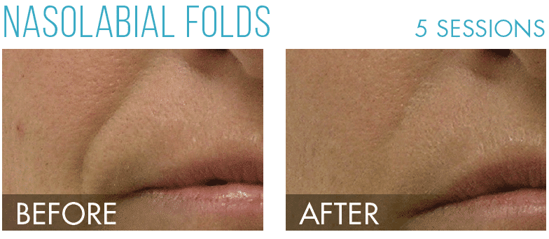 HydraFacial in Richmond, BC illustration 1