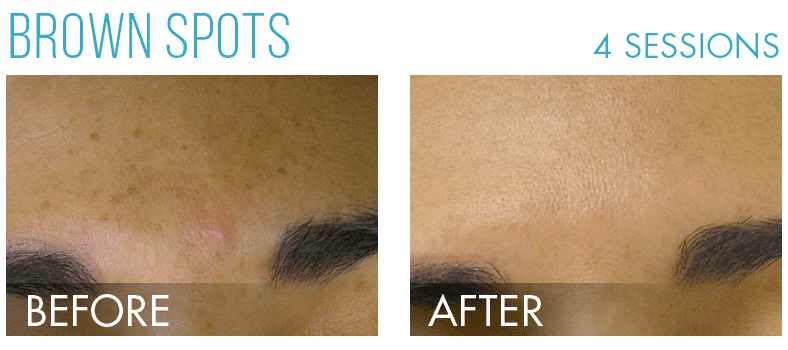 HydraFacial in Richmond, BC illustration 3