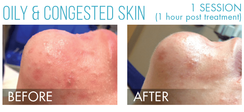 HydraFacial in Richmond, BC illustration 5