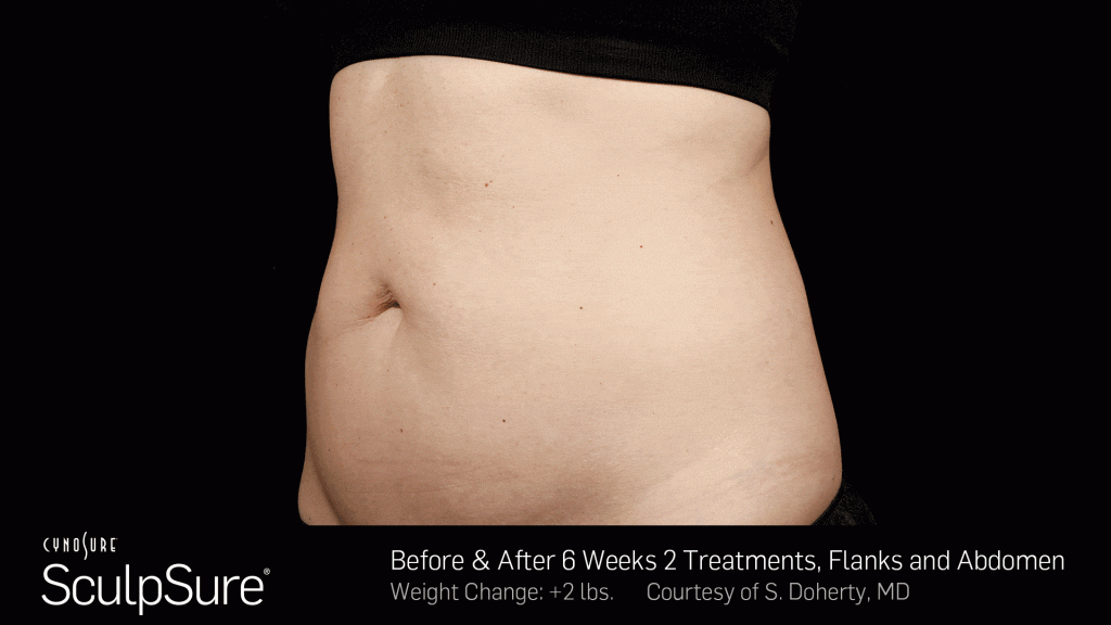 SculpSure Vs CoolSculptin