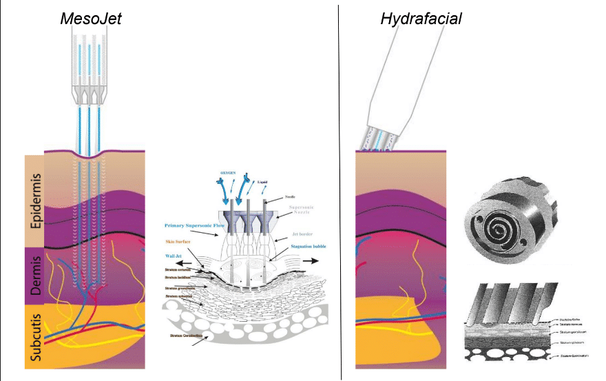 What Will ThermaScan Treatment Do?