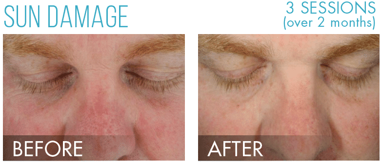 HydraFacial in Richmond, BC illustration 4