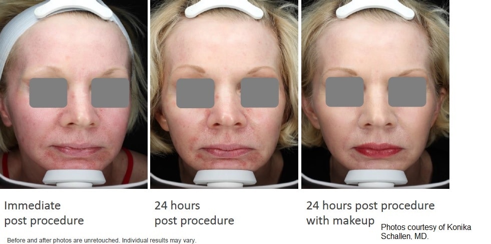 PicoWay Laser Treatment in Richmond, BC illustration 1