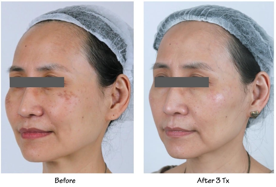 PicoWay Laser Treatment in Richmond, BC illustration 2