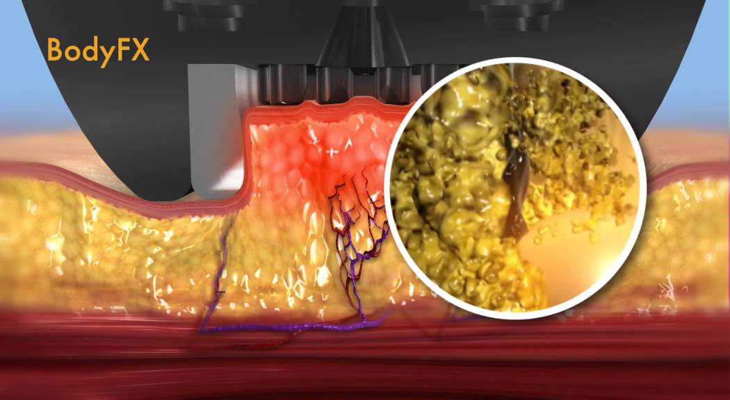 bodyfx animation body contouring
